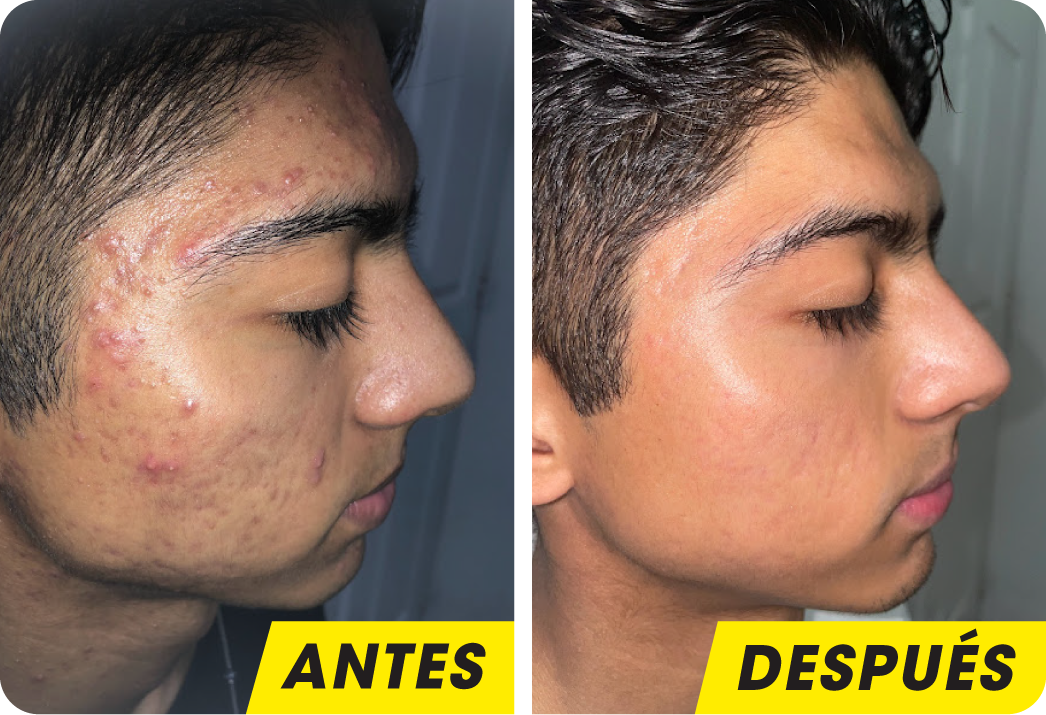 ACNÉ