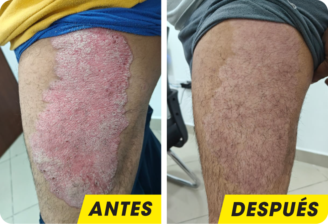 PSORIASIS