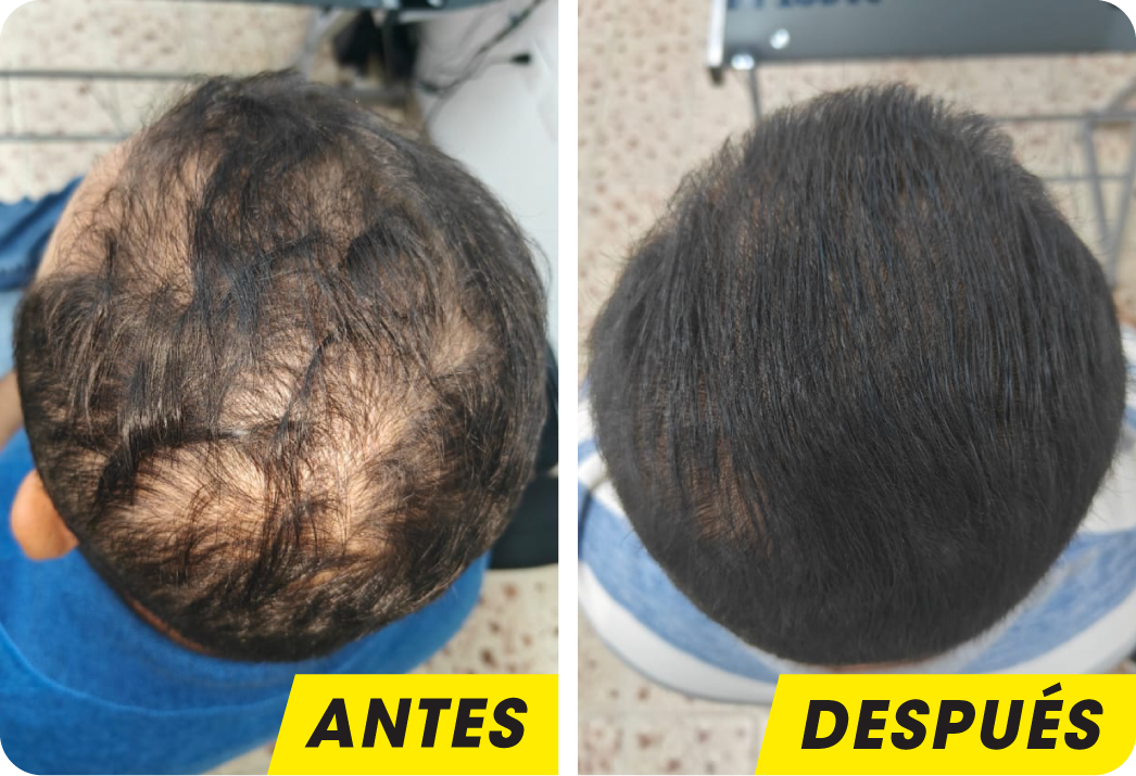 ALOPECIA