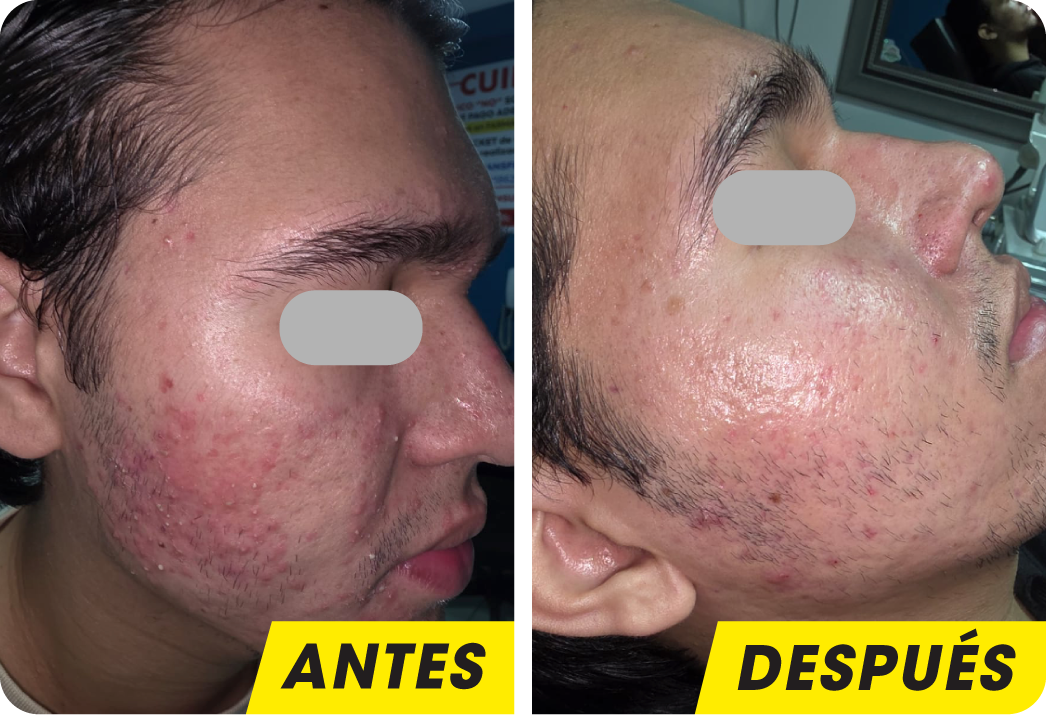 ACNÉ
