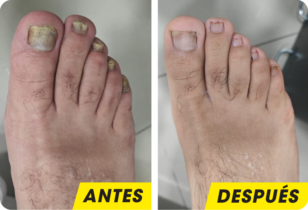 ONICOMICOSIS